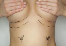 TÜV должен оправдываться в суде из-за скандала имплантантами