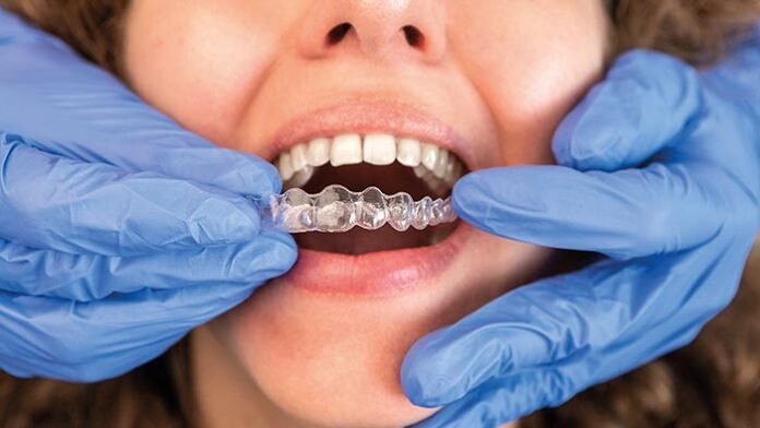 Dentist in gloves applying invisible aligner on female patient t